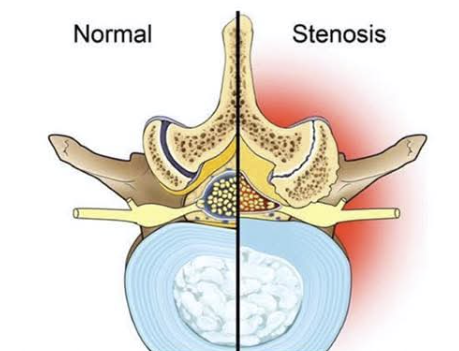 Comparison of a normal lumbar vertebral segment and one with spinal stenosis, showing facet joint hypertrophy and ligamentum flavum thickening narrowing the canal and lateral recess
