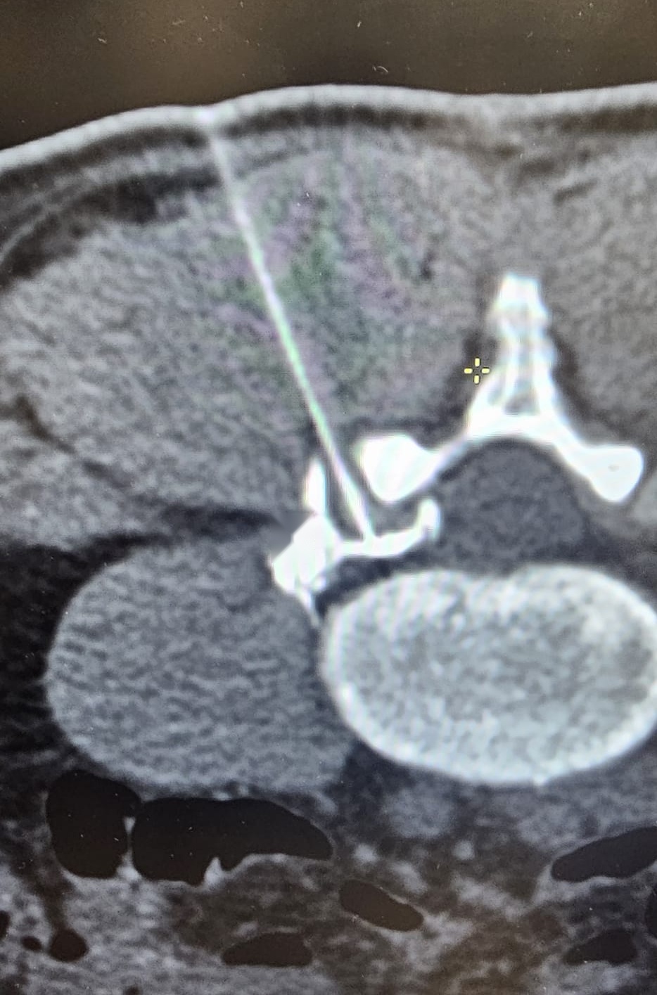 Axial CT image from an actual procedure showing a needle advanced via the transfacet approach, positioned at the facet joint and lateral recess of the lumbar spine